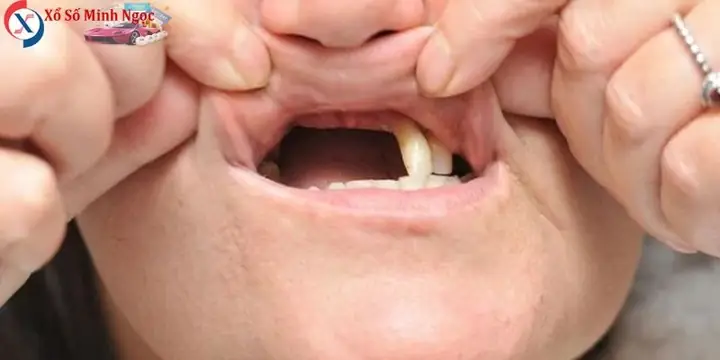 Mơ Rụng Răng Trong Các Văn Hóa