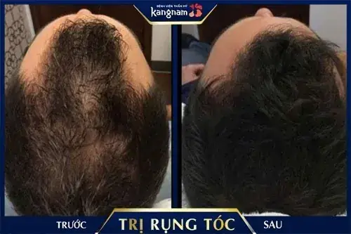 Cách Giải Quyết Tình Trạng Rụng Tóc Hiệu Quả