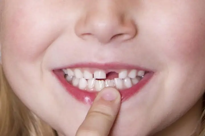 Giải Mã Giấc Mơ Tự Nhổ Răng Sâu Cho Con Mình