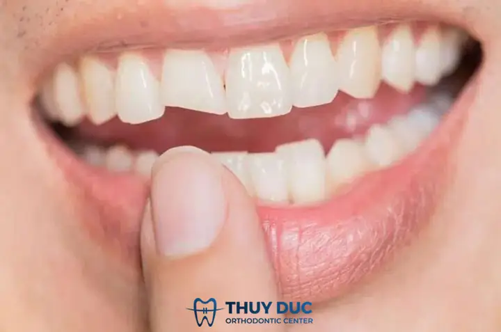 Mơ Gãy Răng Không Chảy Máu Là Điềm Báo Gì?