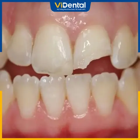Mơ Thấy Gãy Răng Cửa Báo Hiệu Điều Gì?