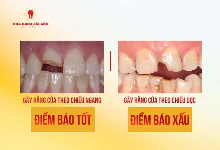 Nằm Mơ Bị Gãy Răng Cửa Là Điềm Báo Tốt Hay Xấu?