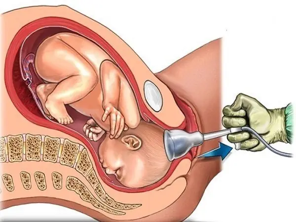 Ngủ Mơ Thấy Mình Bị Sẩy Thai