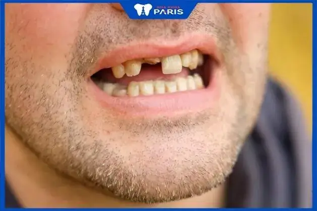Giấc Mơ Răng Cửa Bị Rụng