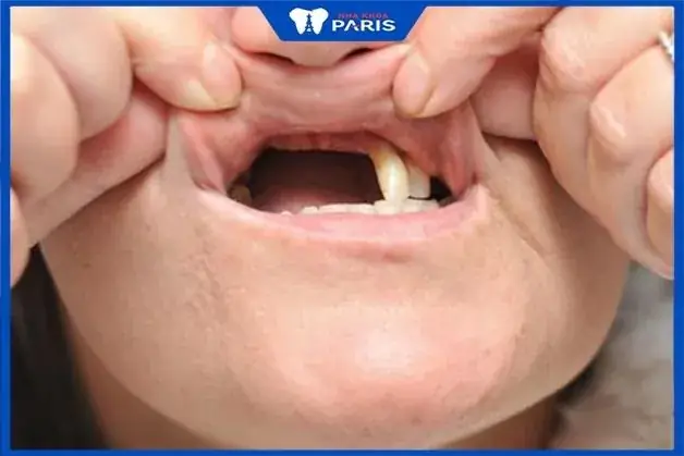 Nằm Mơ Thấy Rụng Nhiều Răng Nhưng Không Bị Chảy Máu