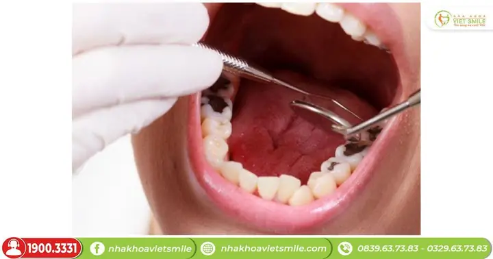 Dấu Hiệu Cho Thấy Có Vấn Đề Về Răng Miệng Khi Nằm Mơ Thấy Rụng Răng