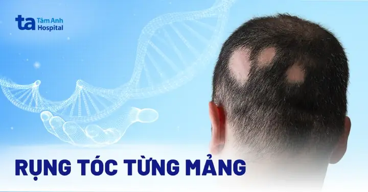 Rụng Tóc Từng Mảng: Nguyên Nhân, Triệu Chứng, Chẩn Đoán, Điều Trị