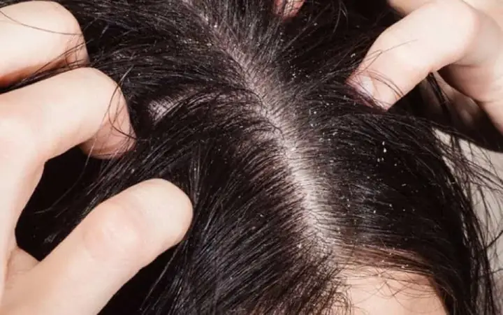 Mộng Thấy Bắt Chấy Cho Người Chết