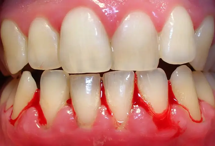 Mơ Thấy Bị Chảy Máu Chân Răng Đánh Con Gì Dễ Trúng?