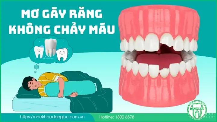 Mộng Gãy Răng Nhưng Không Chảy Máu