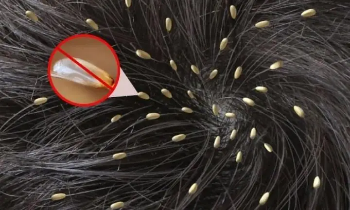 Mơ Thấy Nhiều Chấy Trên Đầu