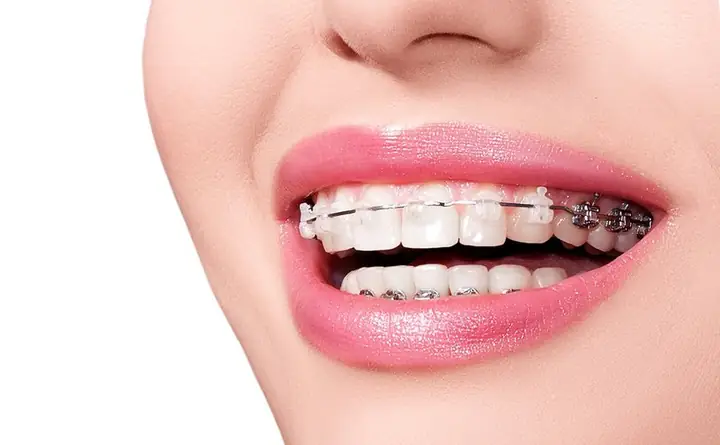 Có Nên Niềng Răng Mọc Lạc Khỏi Hàm Không?