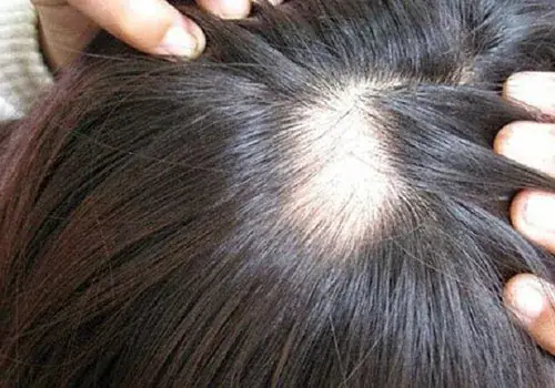Nằm Mơ Thấy Bị Hói Đầu Nghiêm Trọng