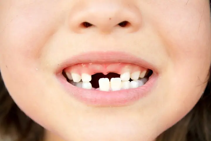 Chiêm Bao Thấy Rụng Răng Cửa Chiêm Bao Thấy Rụng Răng Cửa