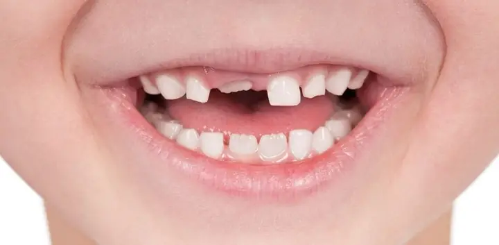 Điềm Báo Nằm Mơ Rụng Răng Hàm Trên Điềm Báo Nằm Mơ Rụng Răng Hàm Trên