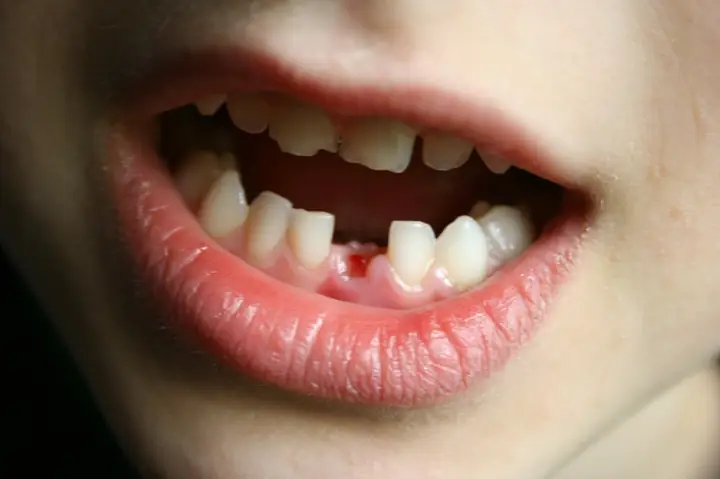 Phân Tích Giấc Mơ Bị Rụng Răng Hàm Dưới