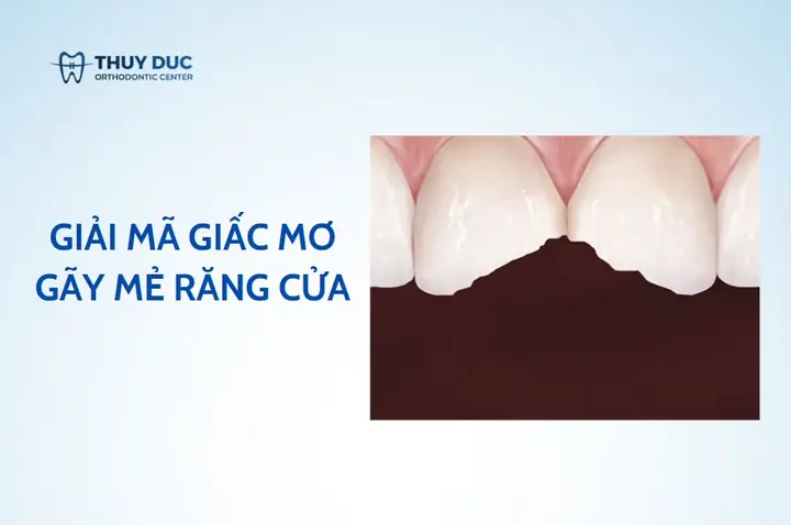 Hoảng Hốt Khi Mơ Gãy Răng Cửa - Giải Mã Giấc Mơ Của Bạn