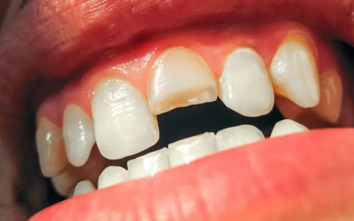Giải Mã Ý Nghĩa Của Nằm Mơ Thấy Mẻ Răng Không Chảy Máu