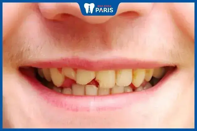 Răng Hàm Trên Bị Mẻ Một Chiếc
