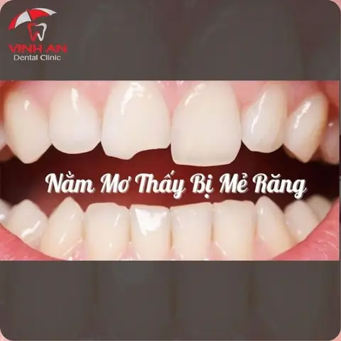 Bí Ẩn Đằng Sau Nằm Mơ Thấy Mẻ Răng - Giải Mã Giấc Mơ