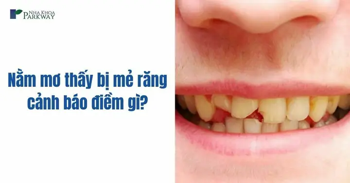 Nằm Mơ Thấy Bị Mẻ Răng Cảnh Báo Điềm Gì? - Nha Khoa Parkway ...
