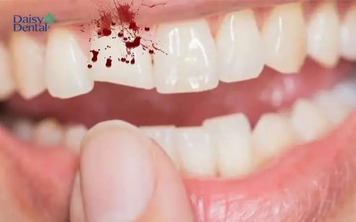 Nằm Mơ Thấy Mẻ Răng Chảy Máu