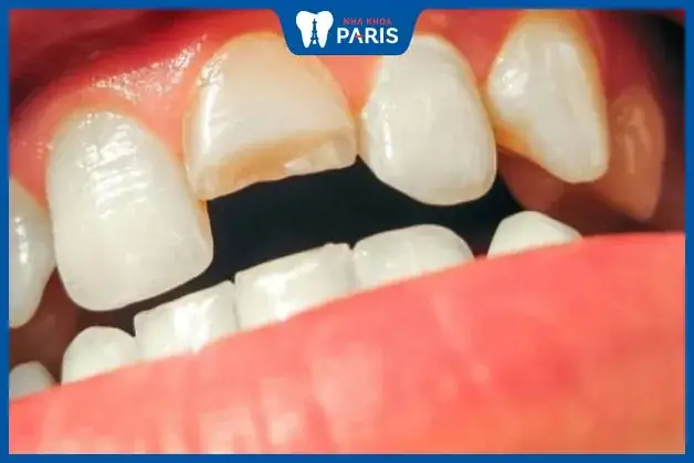Nằm Mơ Thấy Mẻ Răng Không Chảy Máu