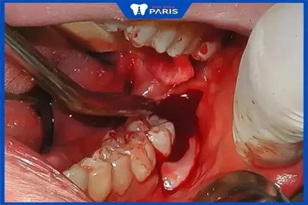 Nằm Mơ Thấy Nhổ Răng Sâu Bị Chảy Máu
