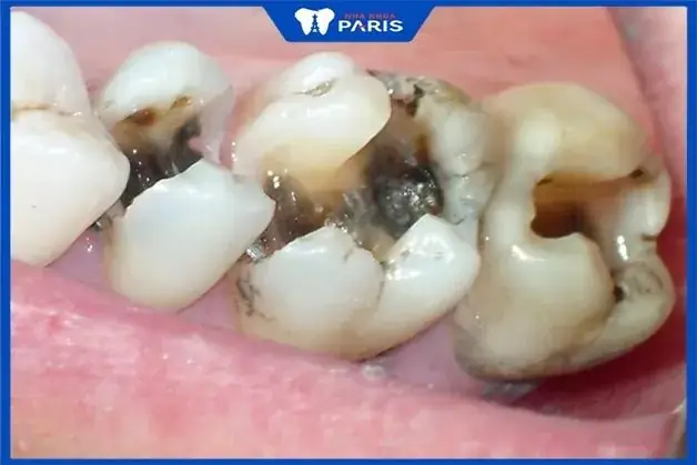 Nằm Mơ Thấy Răng Sâu Bị Vỡ
