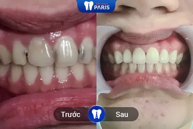 Bọc Răng Sứ Cho Chiếc Răng Sâu