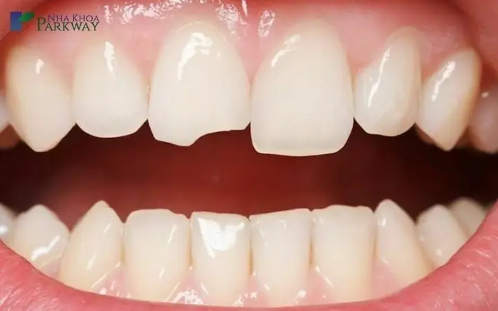 Nằm Mơ Thấy Bị Mẻ Răng Cảnh Báo Điềm Gì?