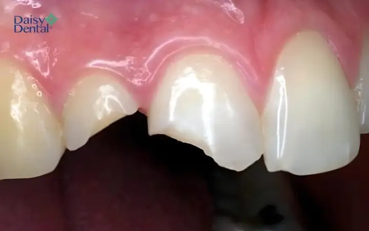 Nằm Mơ Thấy Mẻ Răng Không Chảy Máu