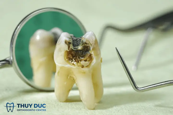 Nằm Mơ Thấy Răng Sâu Bị Vỡ Là Điềm Gì? Giải Đáp Cụ Thể - Nha Khoa ...