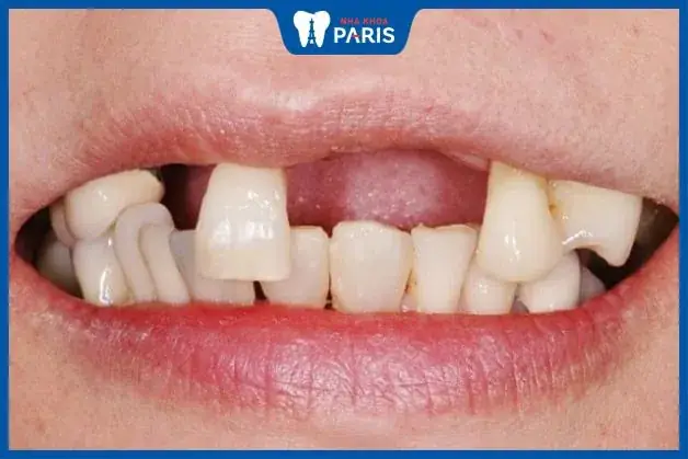 Nằm Mơ Thấy Rụng Nhiều Răng Hàm Trên