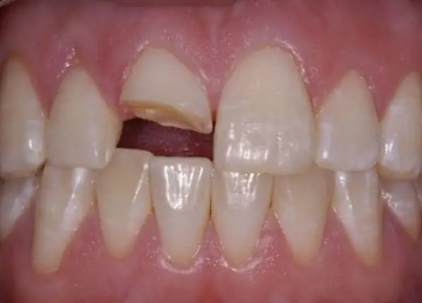 Rụng Khi Nói Chuyện + Không Máu → Cải Thiện “kênh Truyền”