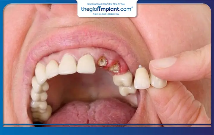 Mơ Thấy Rụng Răng Hàm Trên Không Chảy Máu Có Ý Nghĩa Gì?