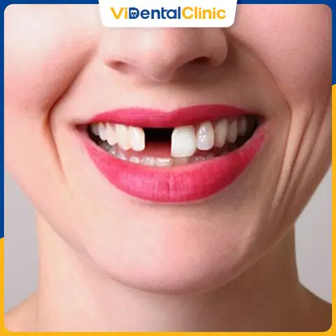 Nằm Mơ Thấy Rụng Răng Là Điềm Gì – Tốt Hay Xấu?