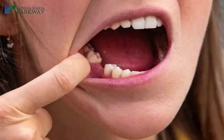 Nằm Mơ Thấy Rụng Răng Hàm Dưới Mà Không Bị Chảy Máu