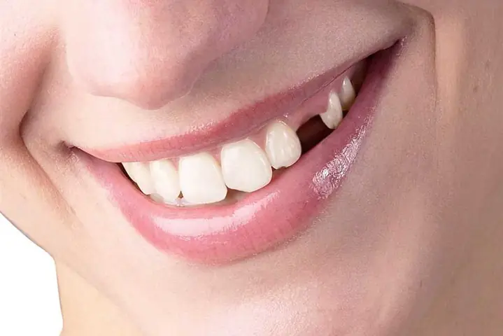 Mơ Thấy Rụng Răng Hàm Trên Không Chảy Máu Có Ý Nghĩa Gì?