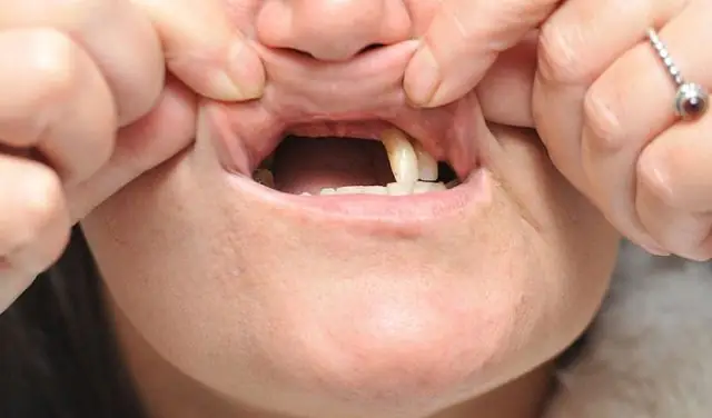 Nằm Mơ Rụng Răng Hàm Trên