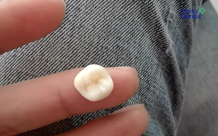 Nằm Mơ Thấy Rụng Răng Số 6 Hàm Trên