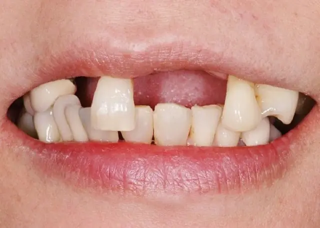 Mơ Thấy Rụng Răng Hàm Trên: