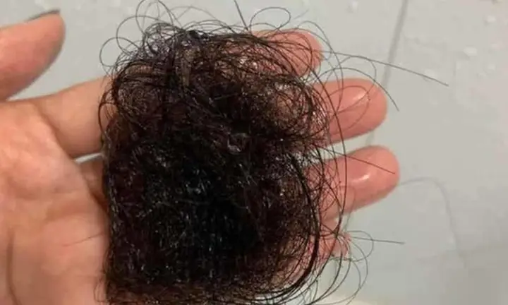 Đàn Ông Nằm Mơ Thấy Rụng Tóc Nhiều