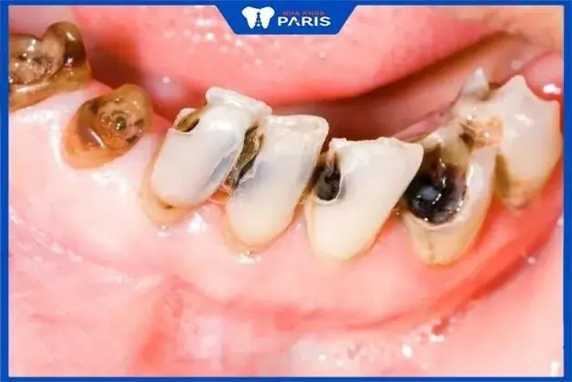 Giải Mã Ý Nghĩa Nằm Mơ Thấy Nhổ Răng Sâu Đánh Số Mấy