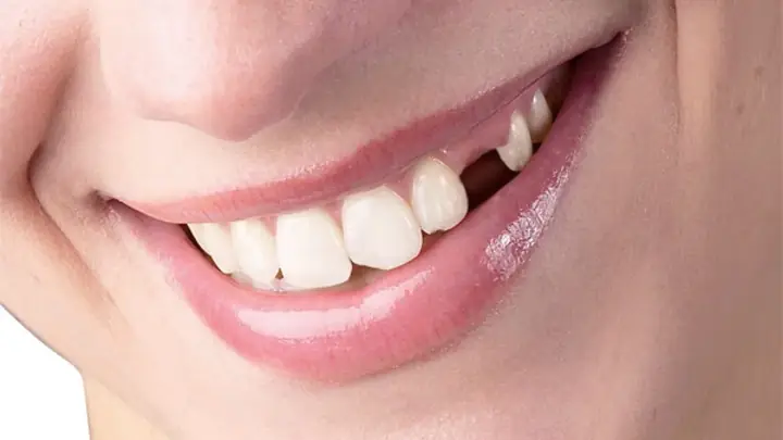 Nằm Mơ Thấy Gãy Răng Có Ý Nghĩa Gì? Điềm Báo Tốt Hay Xấu?