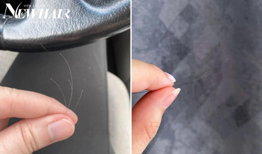 Rụng Tóc Có Chân Trắng: Dấu Hiệu Bệnh Lý Hay Sinh Lý? Hình ảnh sợi tóc rụng có phần chân màu trắng